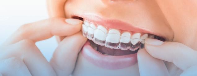 Parceria entre Simples Dental e CA® Clear Aligner: entenda como você pode se beneficiar